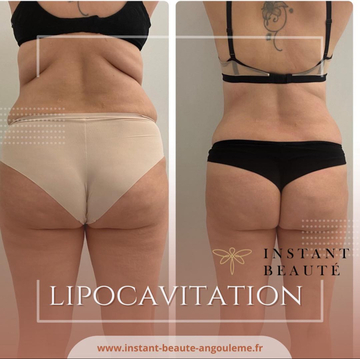 Lipocavitation et radiofréquence à Angoulême