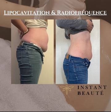 Lipocavitation et radiofréquence à Angoulême