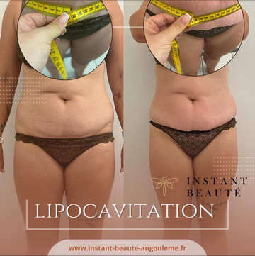 Lipocavitation et radiofréquence à Angoulême