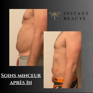 Lipocavitation et radiofréquence à Angoulême