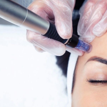 Microneedling 